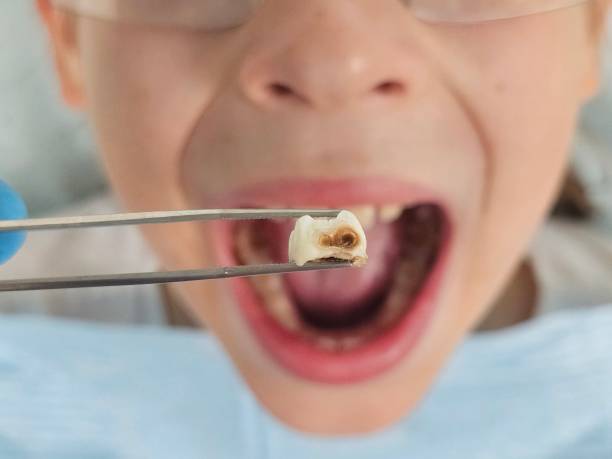 Best Knocked-Out Tooth (Avulsed Tooth) Treatment in Mogadore, OH